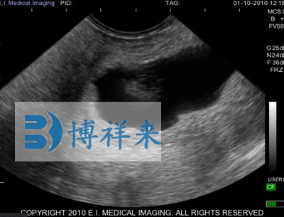 牛懷孕35天影像圖