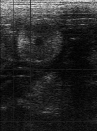 羊胎盤瘤的縱切超聲圖像